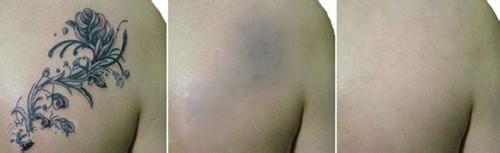 成都洗纹身最好的医院