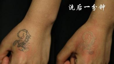 成都洗纹身最好的医院